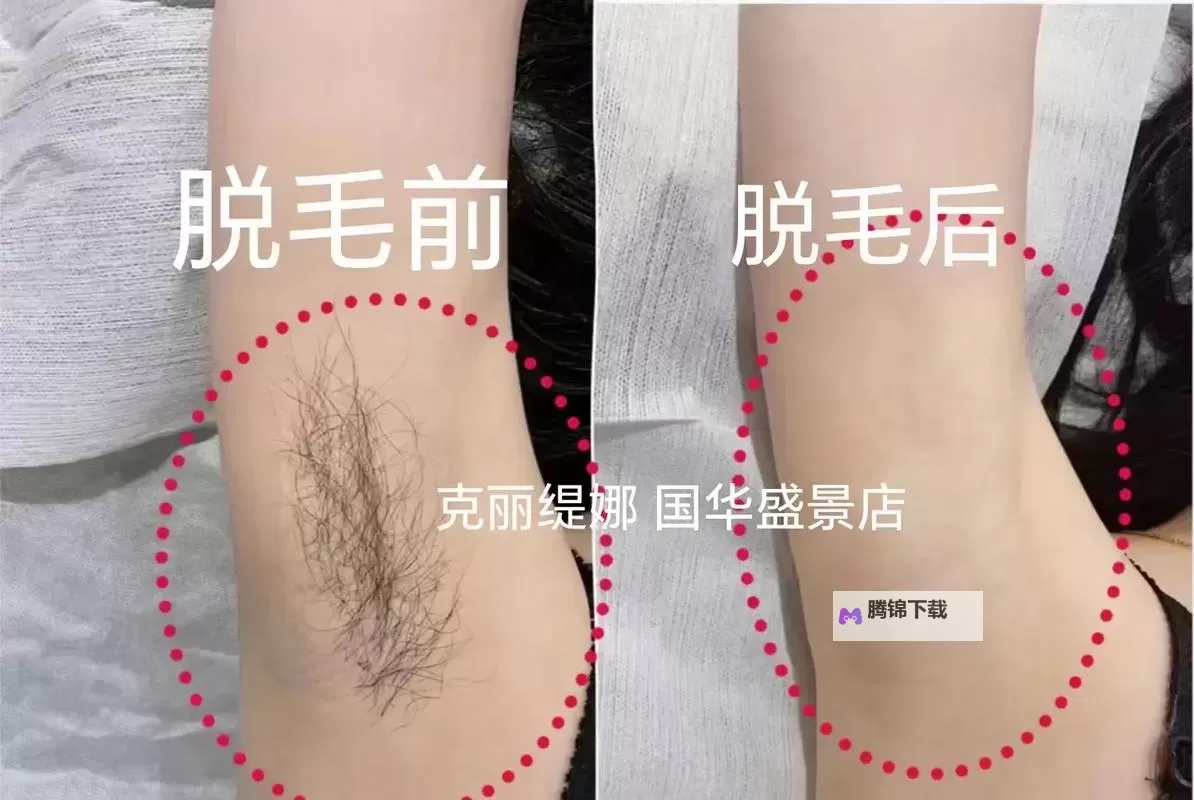 永久脱毛网：解锁肌肤光滑的现代美学之旅图1